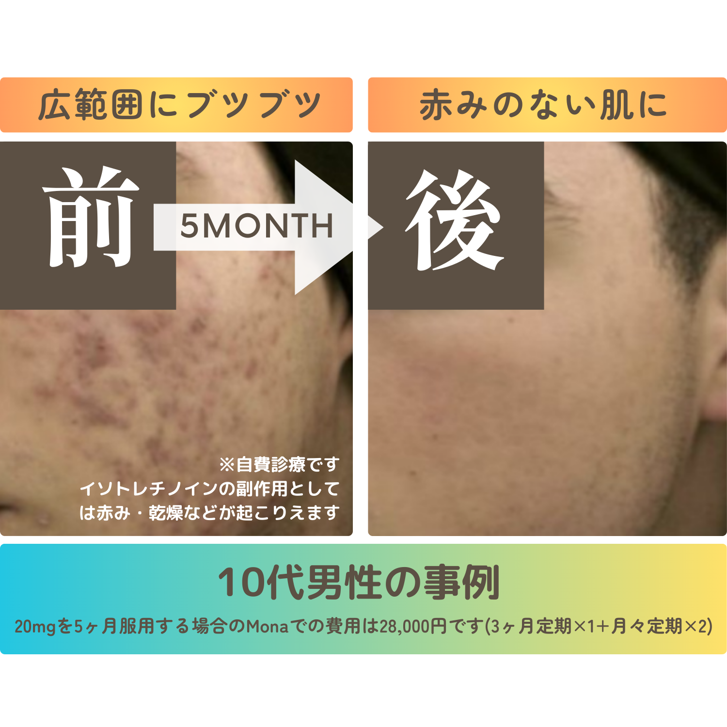 難治性ニキビ97%改善イソ(アクネトレント)